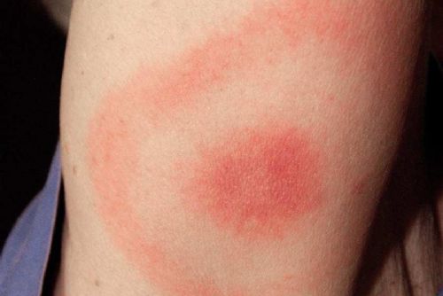 obrázek:Výskyt klíšťových nemocí na Vysočině: borelióza výrazně roste, encefalitida mírně klesá